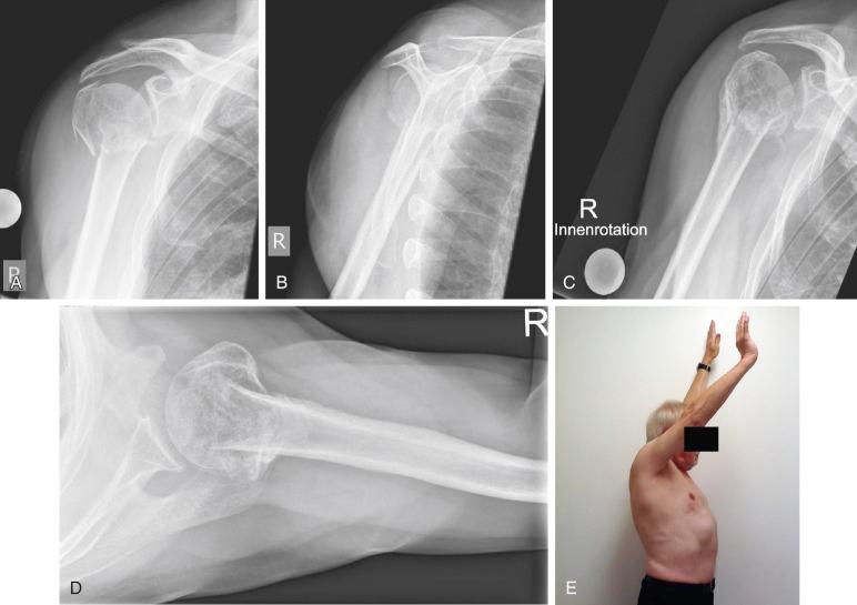 Fig. 47.31, A 75-year-old man with valgus impacted three-part fracture. Initial radiographs, anterior-posterior (A) and lateral views (B). (C–E) Radiographic and clinical follow-up after 3 months showing valgus malunion of the head fragment and superior displacement of the greater tuberosity but a good functional result and a satisfied patient.