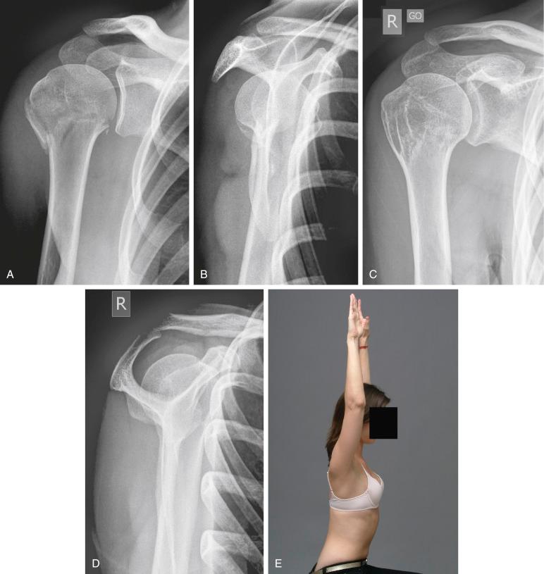 Fig. 47.32, A 35-year-old woman with a one-part fracture. Initial radiographs, anterior-posterior (A) and lateral views (B). (C–E) Radiographic and clinical follow-up after 6 months with anatomic healing of the fracture and good functional result.