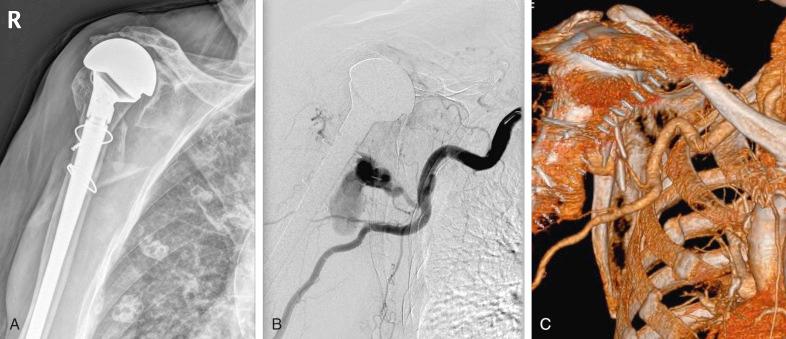 Fig. 47.6, Radiograph (A), computed tomography (CT) arthrography (B), and three-dimensional CT reconstruction (C) of the shoulder of an 82-year-old woman with fracture of the proximal humerus and lesion of the posterior circumflex artery.