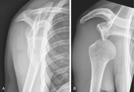 Fig. 47.9, (A and B) Lateral or scapular Y in an anterior dislocation.