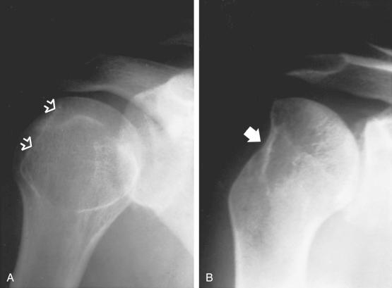 Fig. 47.10, Examples of pathologic findings seen with rotational anterior-posterior views after anterior dislocation and reduction. (A) Internal rotation. A Hill-Sachs posterolateral humeral head impression fracture can be noted. (B) External rotation. The greater tuberosity is missing from its normal location on the humerus after a displaced two-part greater tuberosity fracture and anterior dislocation.