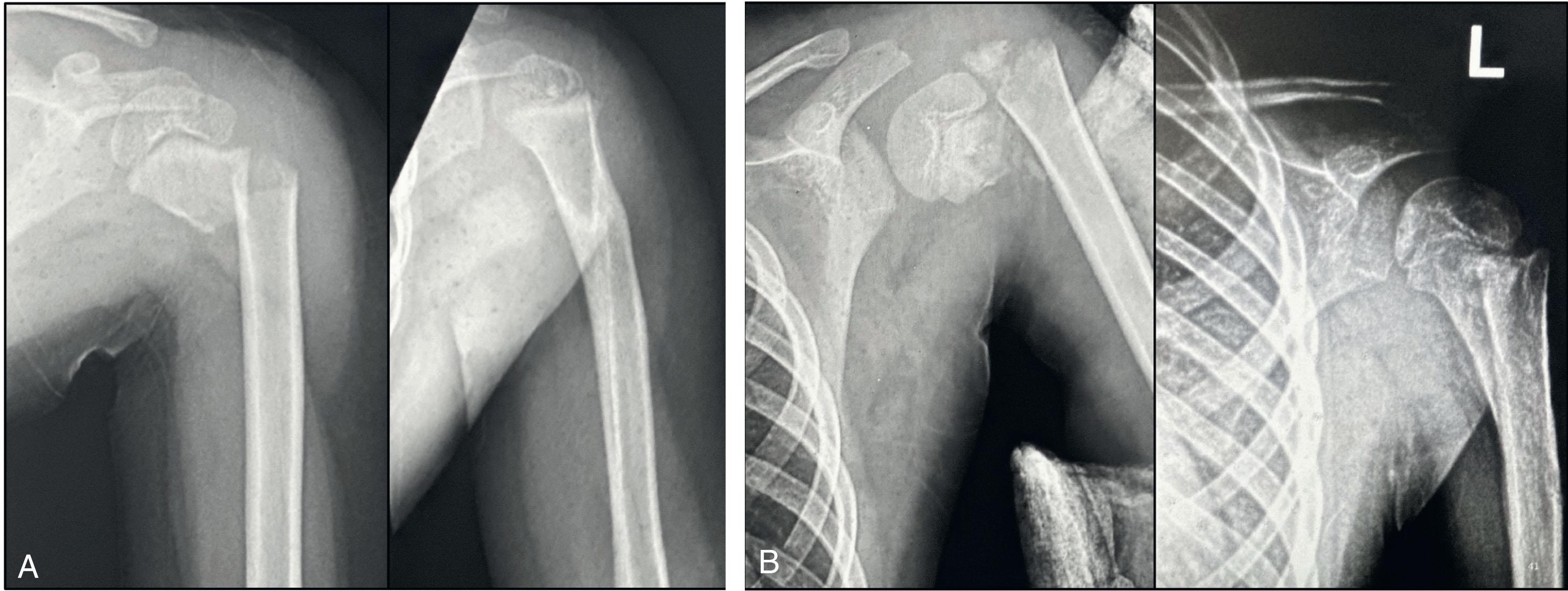 Fig. 1.2, Significant remodeling potential of the proximal humerus. (A) A 4-year-old child, and (B) a 12-year-old preadolescent, at injury and 6 months postinjury.