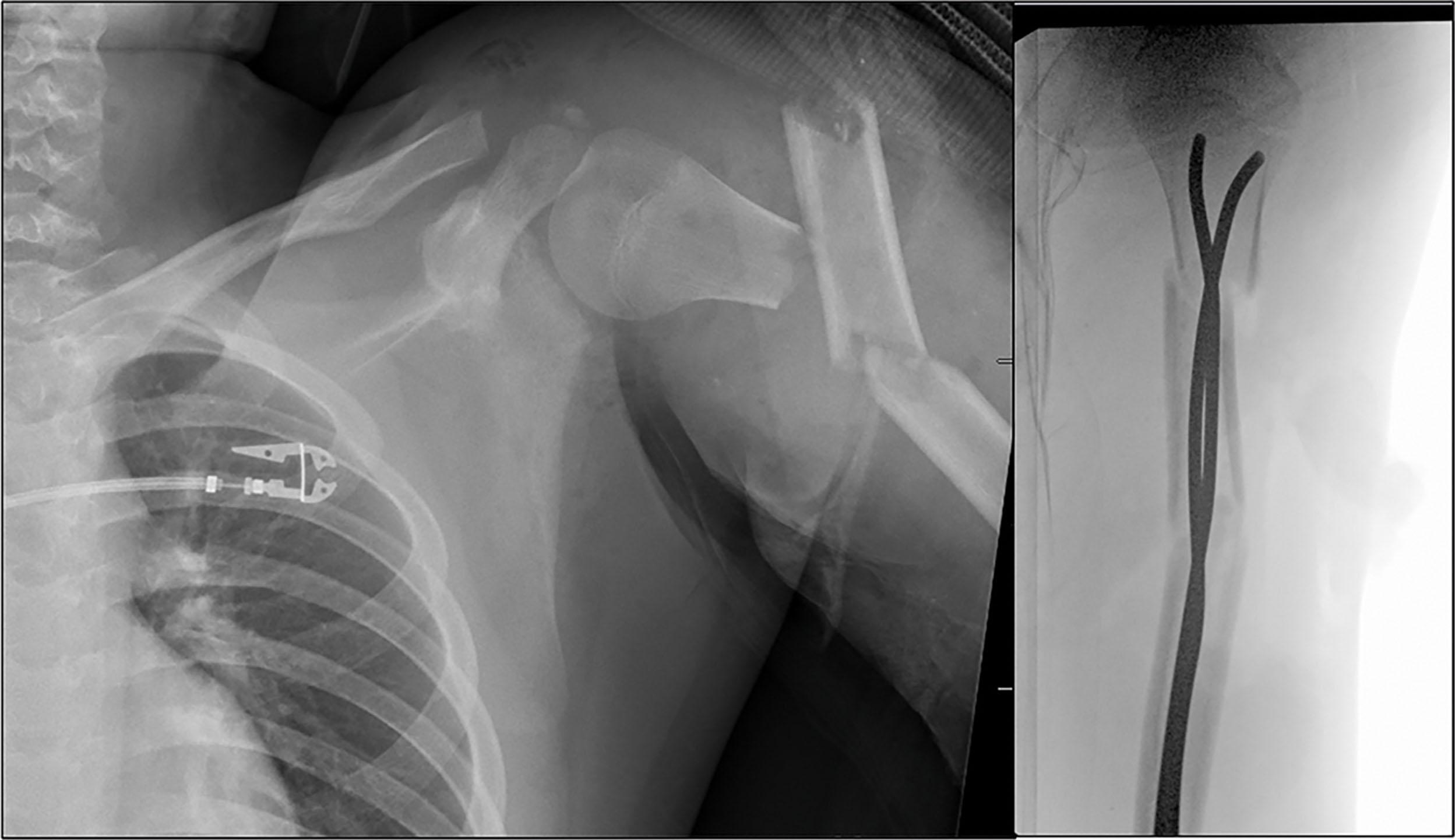 Fig. 1.3, Approximately 60%–80% fill at the isthmus with two-implant ESIN. This is in a 14-year-old male with a grade 3 open segmental humerus fracture.