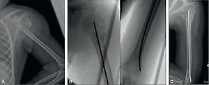 Fig. 1.4, Single Elastic Stable Intramedullary Nailing technique. This is in a 7-year-old female with a severely displaced proximal humerus fracture secondary to skateboarding (A) at injury, (B) intraoperatively, and (C) 2 months postoperatively.