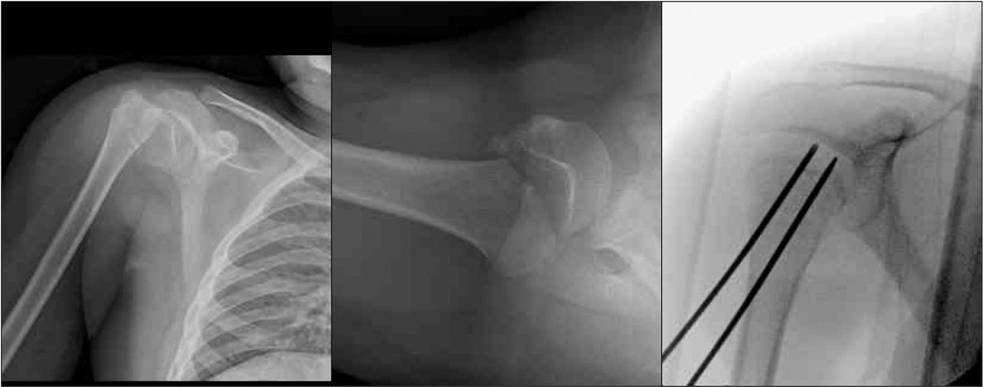 Fig. 1.5, Distal to proximal closed reduction percutaneous pinning technique, crossing into the epiphysis. This is in a 14-year-old male with a displaced fracture secondary to dirt bike injury, utilizing 2.0-mm smooth pins.