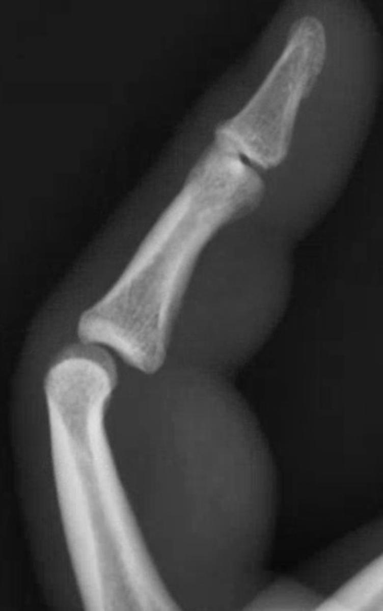 Fig. 80.2, Joint incongruency from volar-rotatory proximal interphalangeal joint dislocation. Note the condyles of the proximal phalanx are aligned while those of the middle phalanx are not.