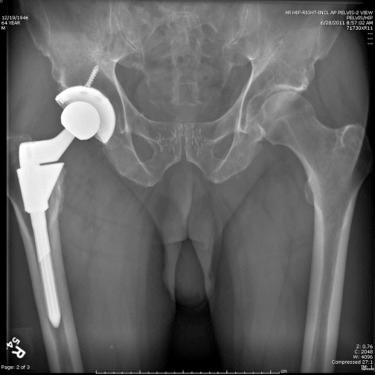 FIGURE 62.2, Postoperative anteroposterior radiograph of the pelvis shows revision with Emperion stem.
