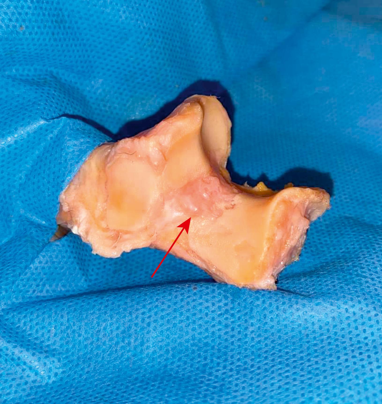 Fig. 51.1, View from the lateral aspect of the olecranon of a cadaveric specimen indicated the bare spot (arrow) between the coronoid and olecranon articular areas.