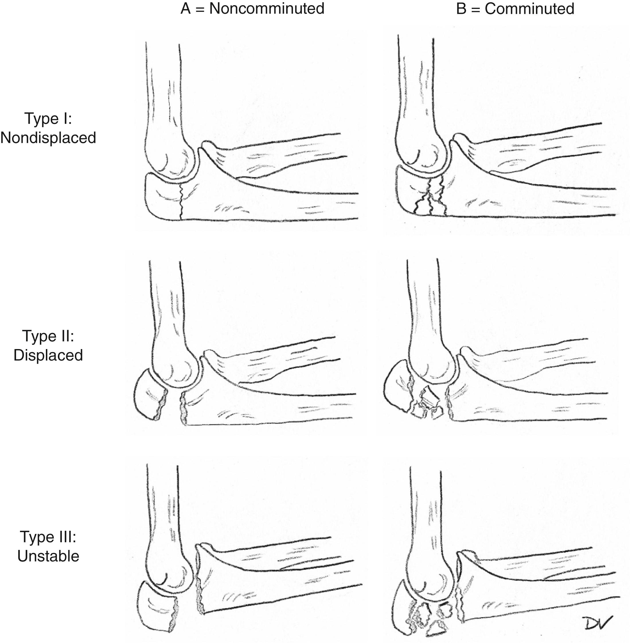 Fig. 51.2, Mayo classification of olecranon fractures.