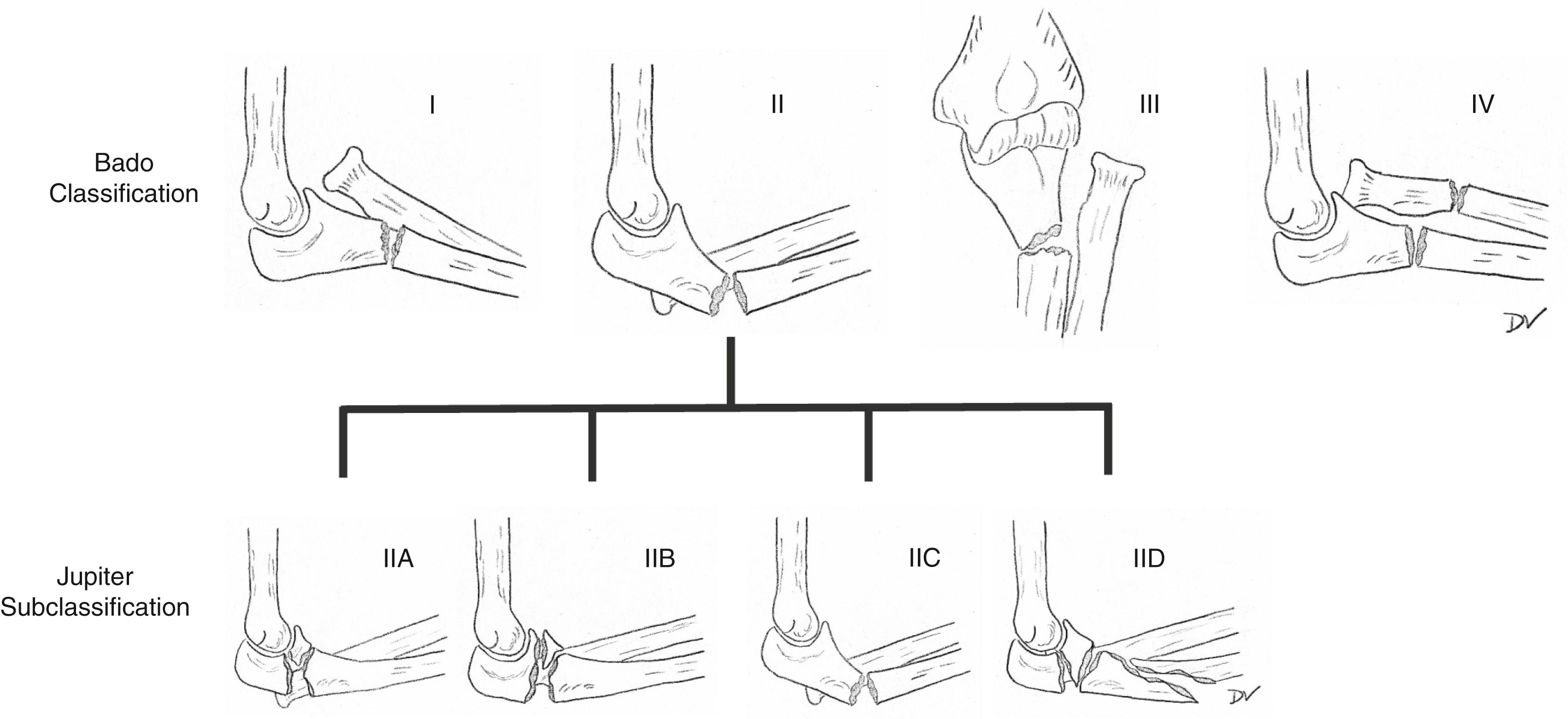 Fig. 51.3, Bado classification of Monteggia fractures with Jupiter subclassification of posterior Monteggia fractures.