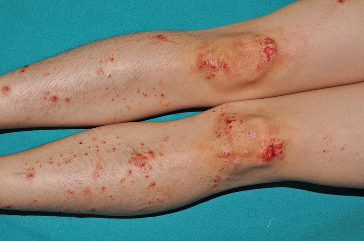 Fig. 4.1, Nonspecific lesions in atopic dermatitis.