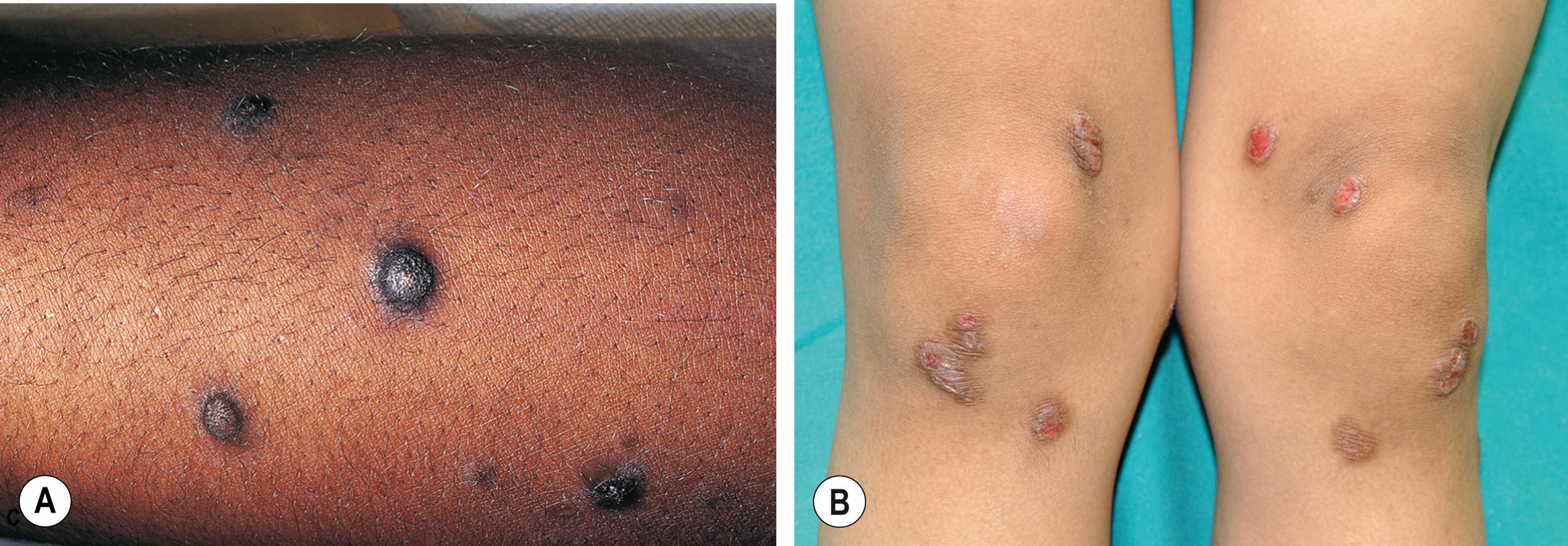 Fig. 4.5, Prurigo nodularis.