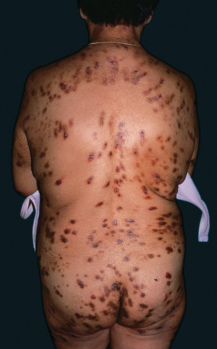 Fig. 4.6, Multiple lesions of prurigo nodularis.