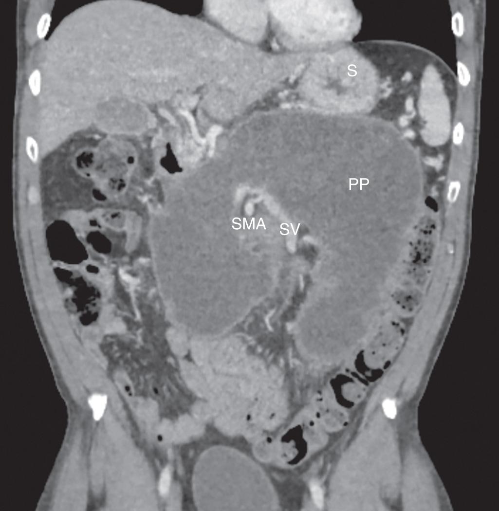 FIGURE 93.1, Computed tomography scan showing a large horseshoe-shaped pancreatic pseudocyst (PP) after acute gallstone pancreatitis. S, Stomach; SMA, superior mesenteric artery; SV, splenic vein.