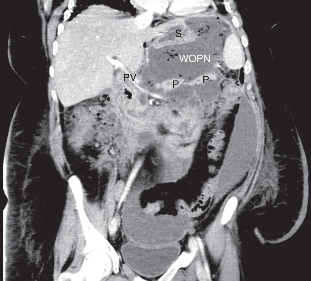 FIGURE 93.2, Computed tomography scan showing walled-off pancreatic necrosis (WOPN) . P, Pancreas; PV, portal vein; S, stomach.)
