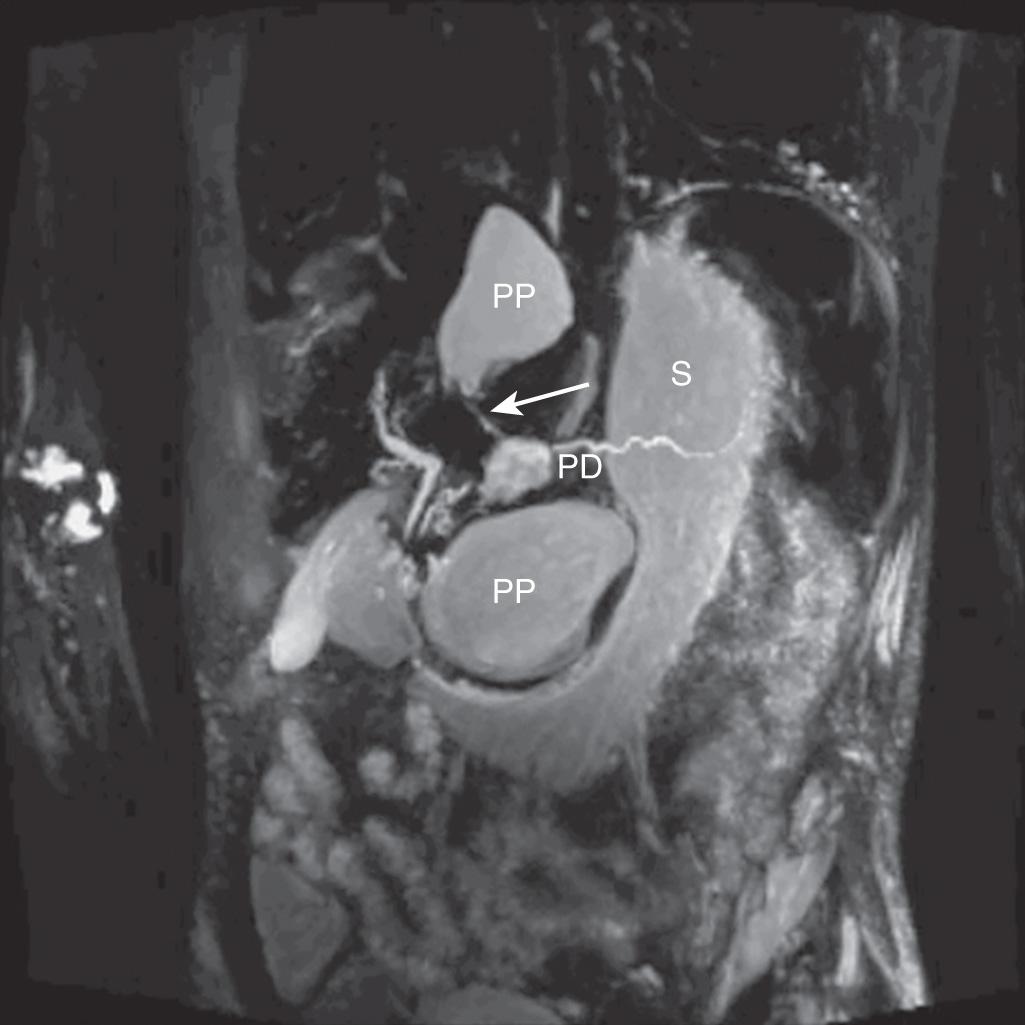 FIGURE 93.3, Magnetic resonance cholangiopancreatography of pancreatic duct (PD) disruption with pseudocyst. Thick slab, heavily T2-weighted magnetic resonance cholangiopancreatography image of a patient with smoldering pancreatic symptoms 3 weeks after an acute pancreatitis event with suspected pancreatic duct fistula based on fluid collections on a computed tomography scan. A small communication between the disrupted main pancreatic duct and the pseudocyst is demonstrated (arrow) . PP, Pancreatic pseudocyst; S , stomach.