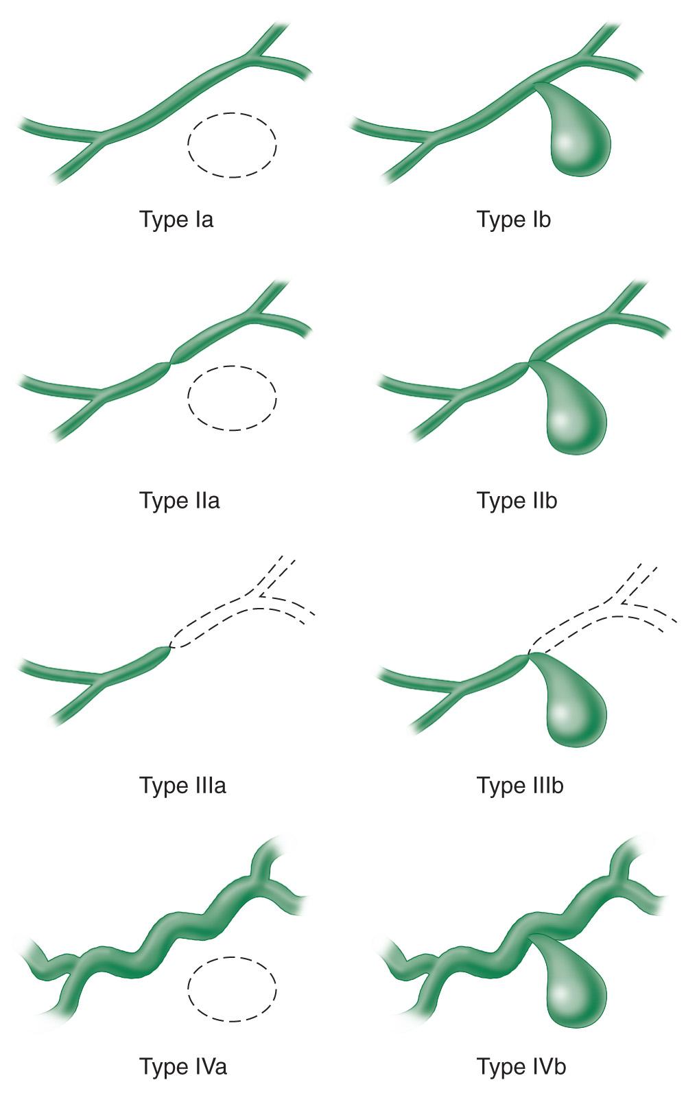 FIGURE 93.4, Nealon classification of pancreatic ductal disruption and pseudocyst formation. Type I is a normal main pancreatic duct. Type II is a pancreatic duct stricture. Type III is pancreatic duct occlusion (disconnected pancreatic duct syndrome). Type IV depicts chronic pancreatitis. Subtypes a represent no radiographically demonstrable communication between the pancreatic duct and the pseudocyst. Subtypes b represent communication between the pancreatic duct and the pseudocyst.