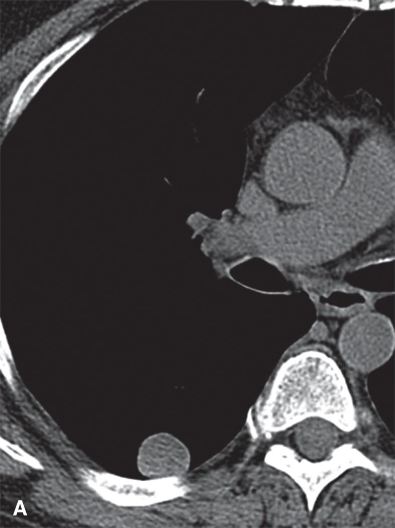 Figure 19.1, (A) CT scan of chest shows a well-defined low-density nodule in right lower lobe suggestive of hamartoma. (B) Gross photograph of a pulmonary hamartoma shows a firm, homogeneous, glistening white nodule that stands out from the lung cut surface.