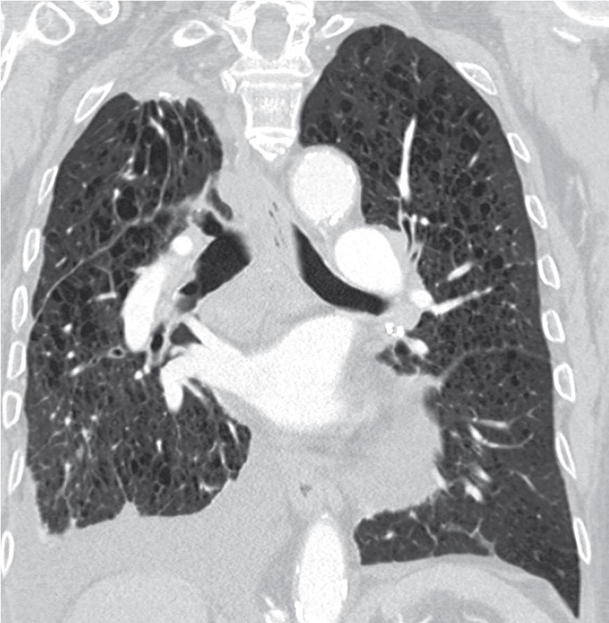 Figure 19.11, Post contrast CT scan with coronal reconstruction in a patient with past granulomatous infection demonstrates right apical pleural cap and thickening with loss of volume as a sequelae of prior granulomatous disease.