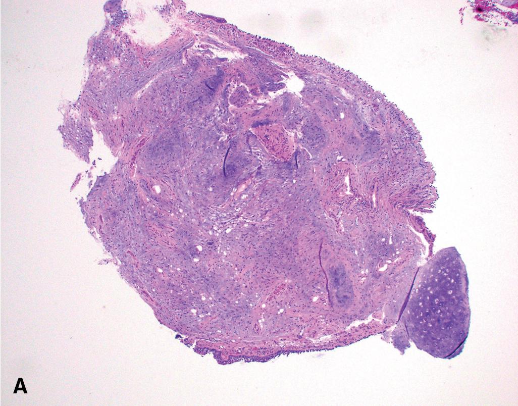 Figure 19.2, (A and B) The tumor is composed of lobules of mature cartilage and adjacent fibroadipose tissue with intervening clefts lined by benign respiratory epithelium.