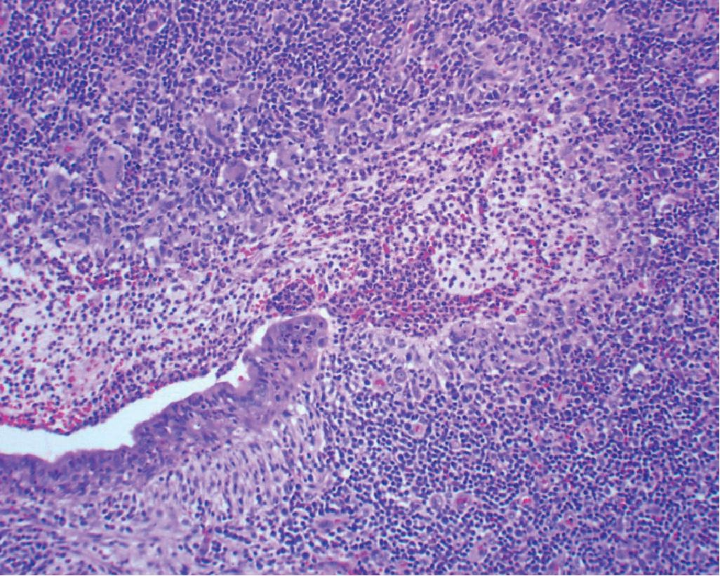 Figure 19.3, The center of this lesion shows a nidus of purulent inflammation within a bronchiole, indicating an old abscess.