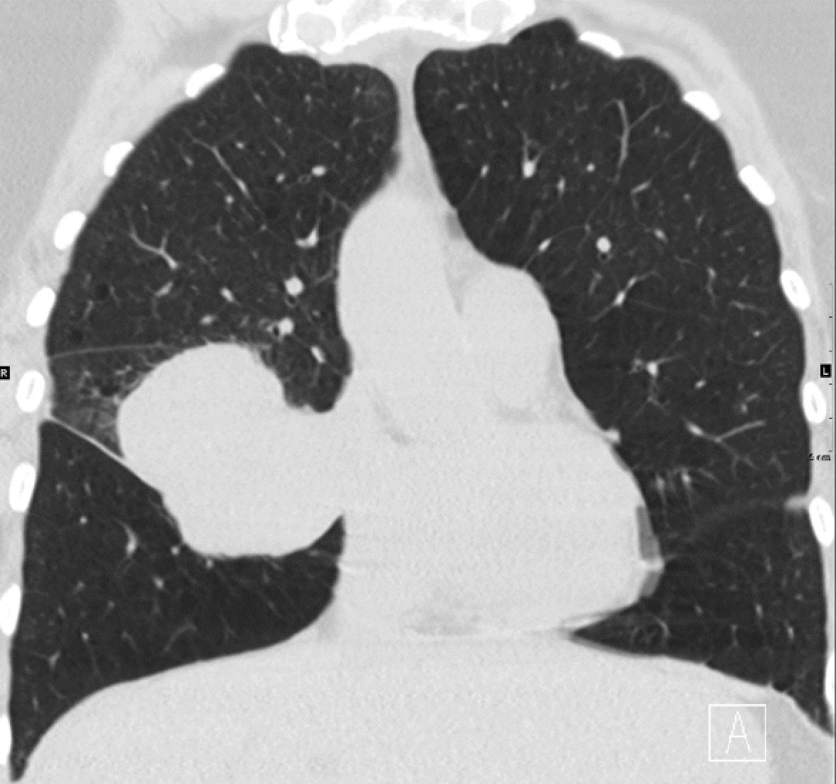 Figure 19.5, CT scan with coronal reconstruction demonstrates a homogeneous lobulated soft tissue mass, later biopsied and resected to confirm inflammatory pseudotumor.