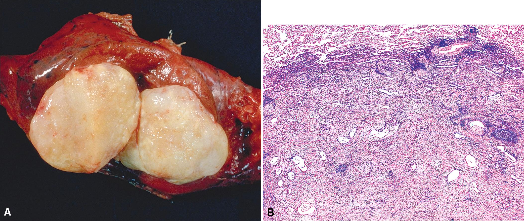 Figure 19.6, (A) Gross specimen showing pulmonary inflammatory pseudotumor with a circumscribed and internally homogeneous white-tan cut surface. (B) This photomicrograph of inflammatory pseudotumor of the lung shows an irregular interface with the surrounding parenchyma, multiple foci of chronic inflammation, and early sclerosis. (C) Fibroinflammatory lesion with numerous plasma cells within a pulmonary inflammatory pseudotumor.