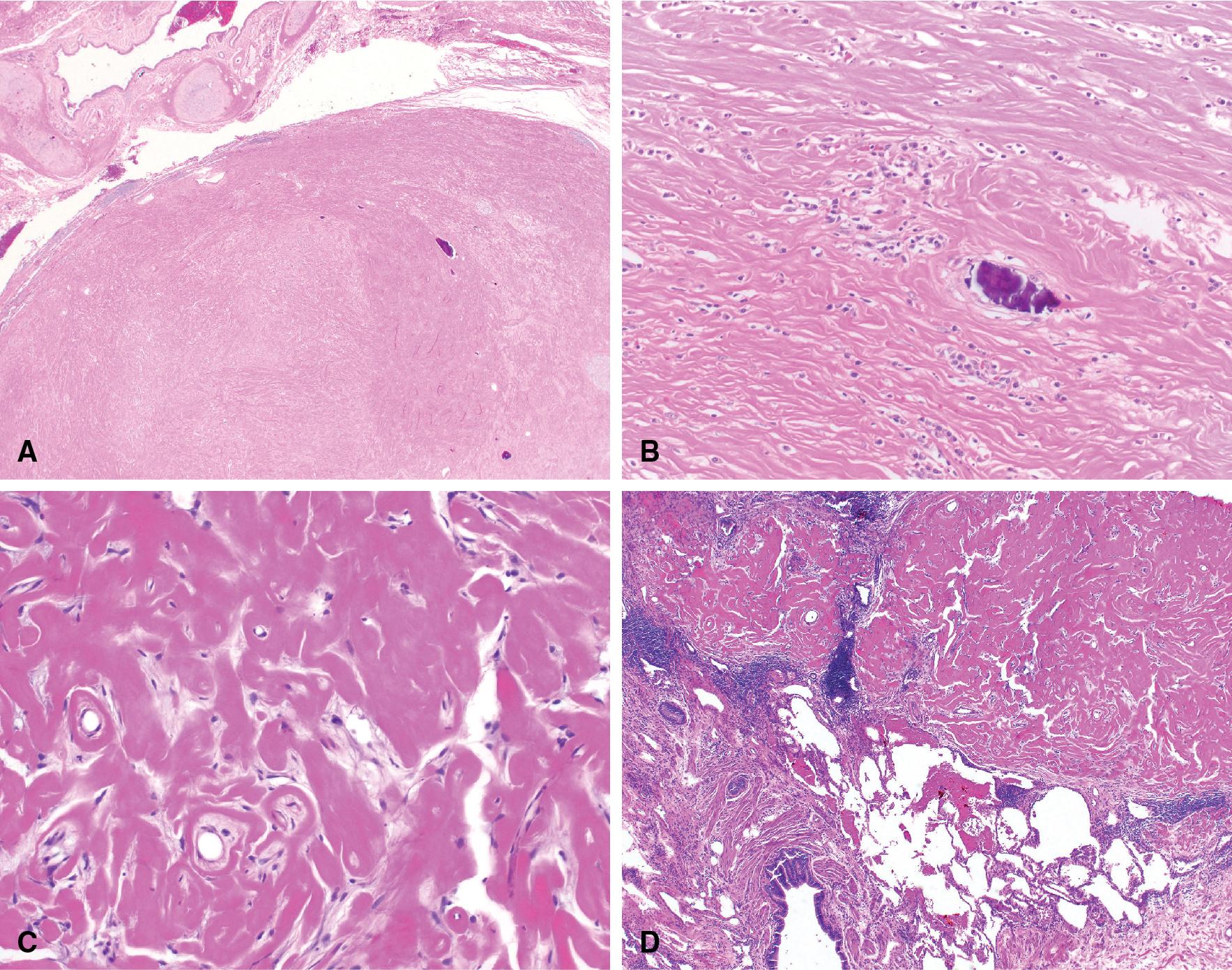 Figure 19.7, (A) Low-power image of pulmonary hyalinizing granulomas shows rounded paucicellular mass of dense and whorled fibrosis adjacent to a bronchus. (B and C) High-power view of lesion shows dense collagen in bundles resembling a keloid scar and scattered small clusters of plasma cells. (D) The edge of the lesion has several clusters of chronic inflammatory cells not present in the center of the mass.