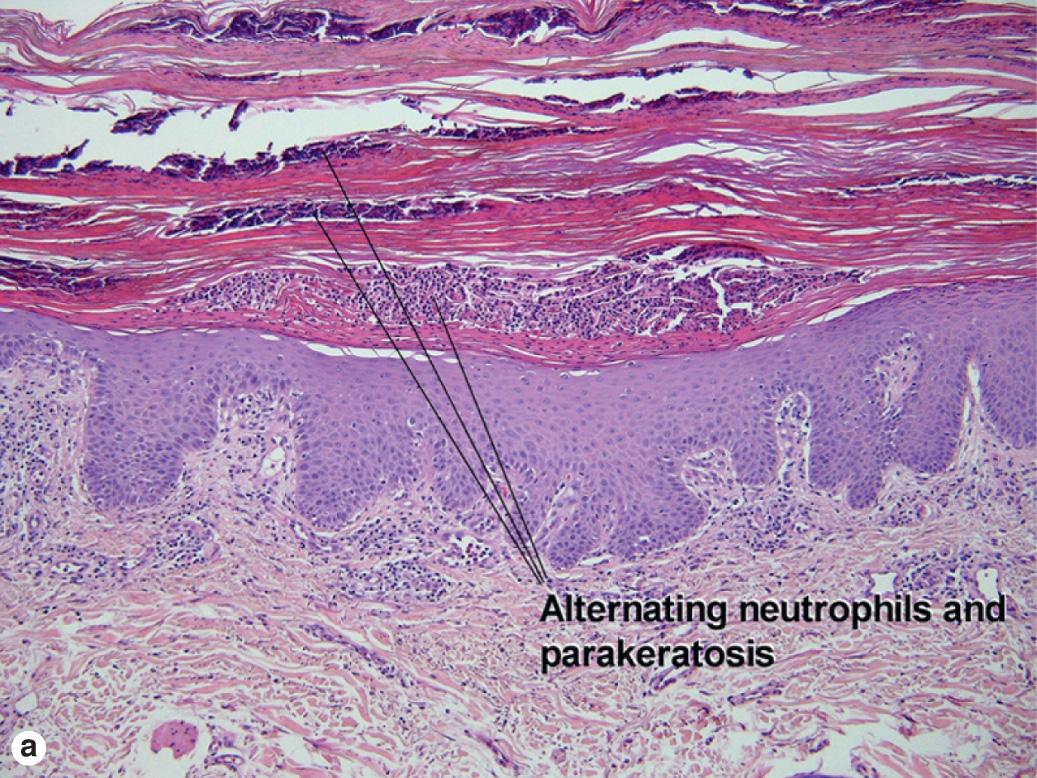 Fig. 8.1, Plaque psoriasis