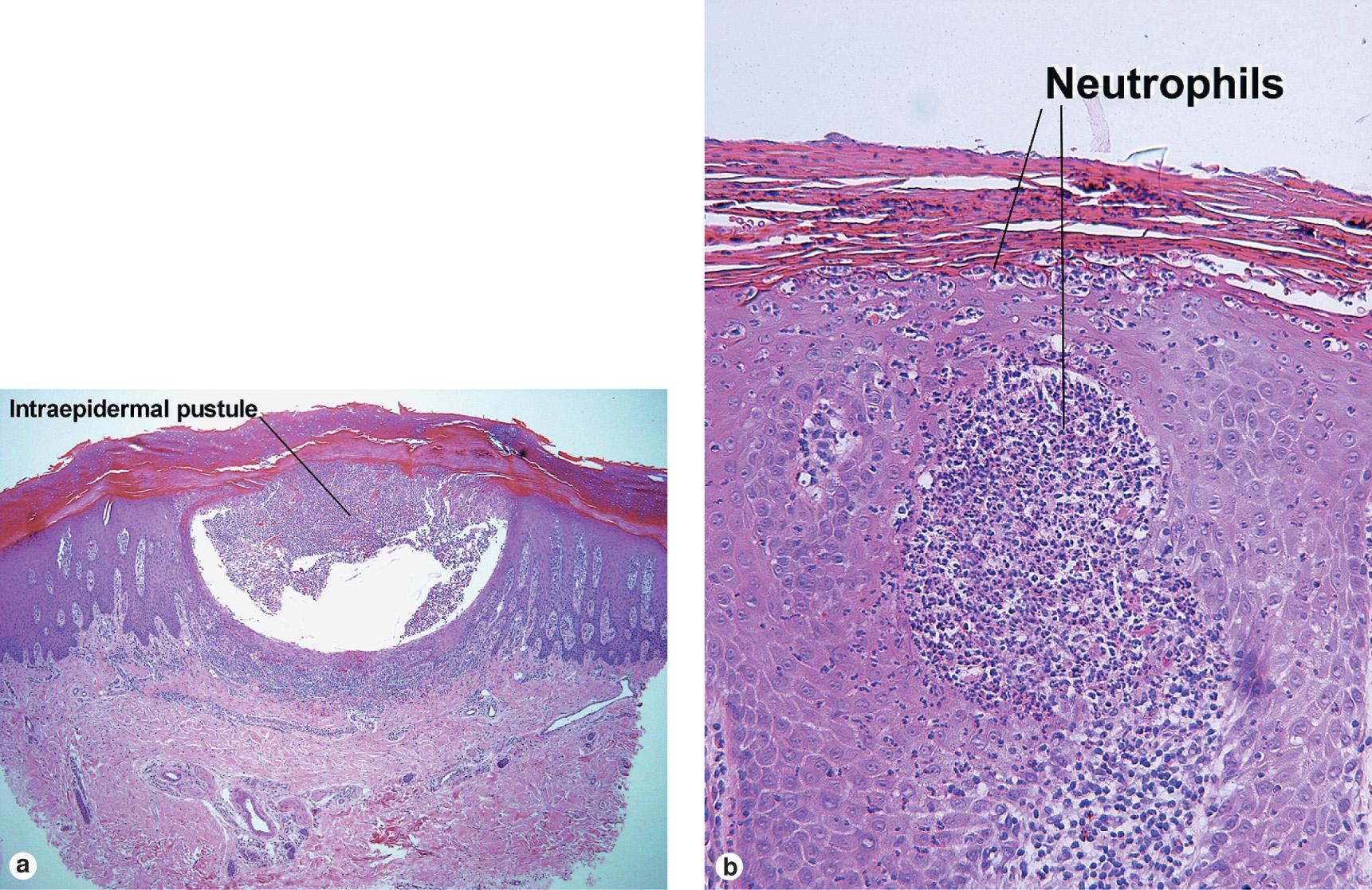 Fig. 8.2, Pustular psoriasis