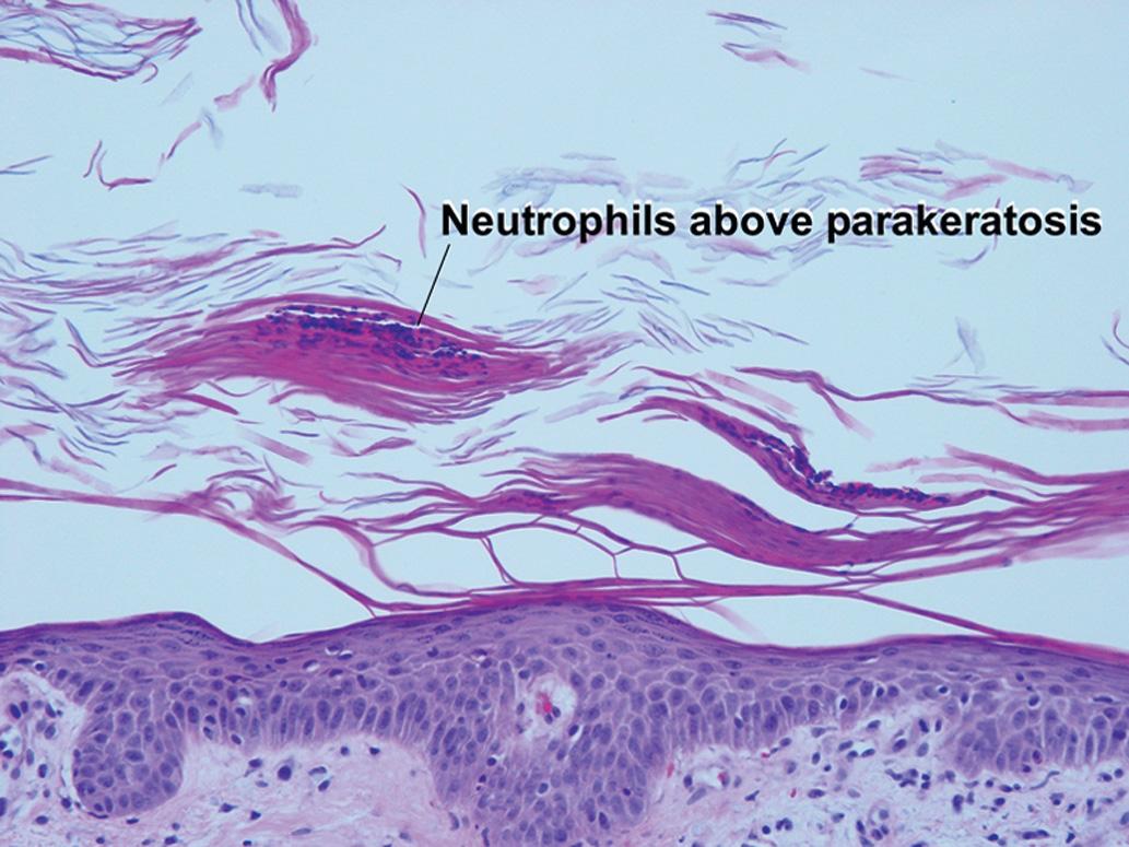 Fig. 8.3, Guttate psoriasis