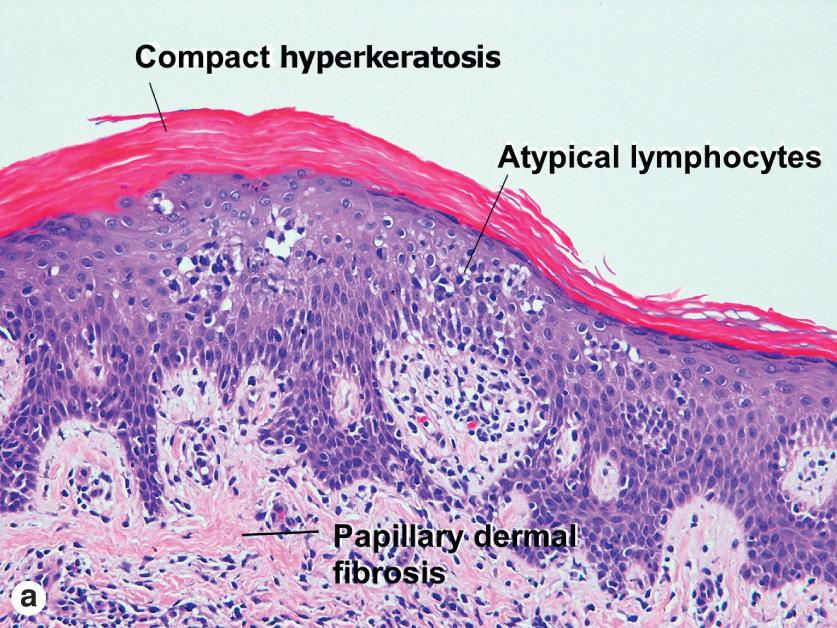 Fig. 8.5, Psoriasiform mycosis fungoides