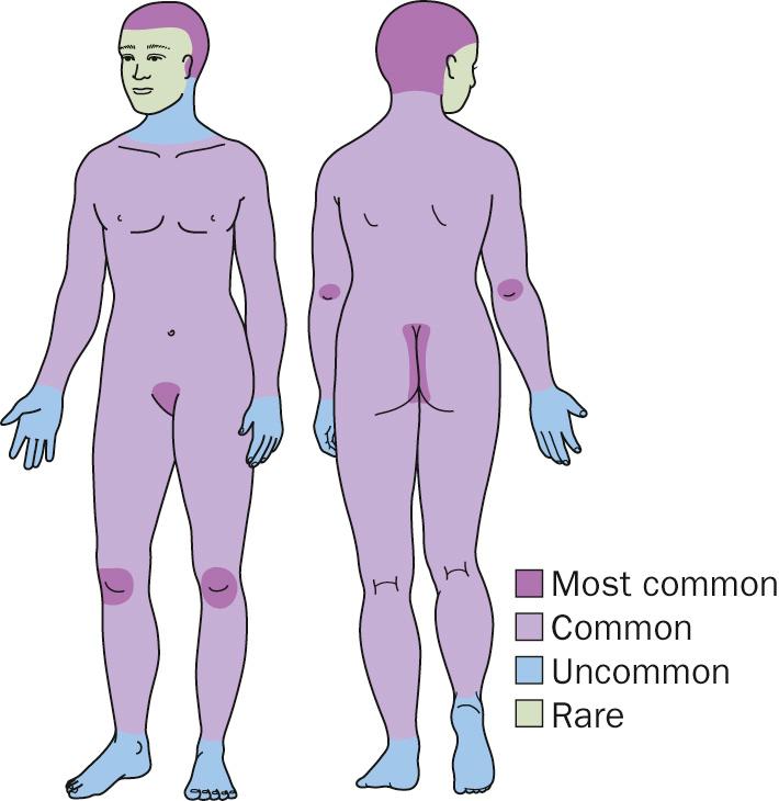 Fig. 5.1, Psoriasis distribution diagram.