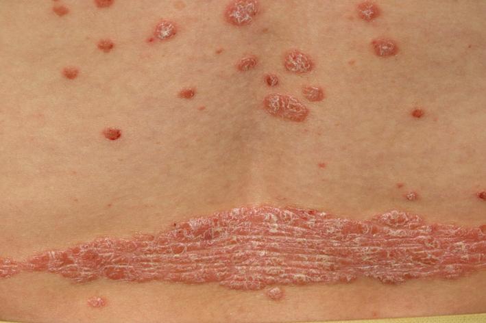 Fig. 5.11, Plaque psoriasis. Notice the thick plaque and scale. Plaque psoriasis and guttate psoriasis occuring simultaneously. These papules and plaques may be mildly itchy.