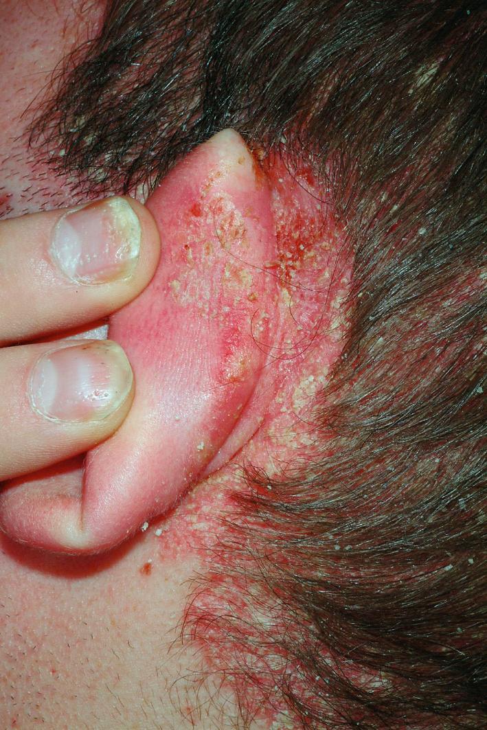 Fig. 5.13, Scalp psoriasis. The posterior auricular folds should be treated with low potency topical corticosteroids and the scalp with higher potency topical corticosteroid shampoos, foams and solutions.