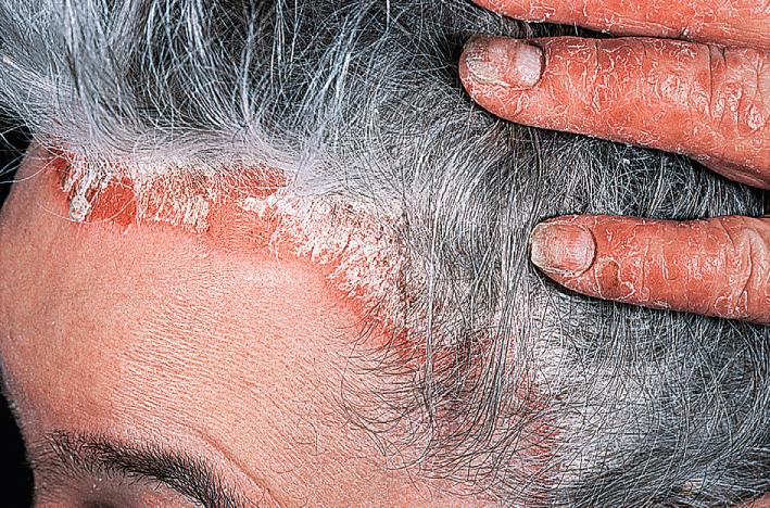 Fig. 5.14, Scalp psoriasis. Dense scale covering a part of or the entire scalp surface is highly characteristic of psoriasis. The scalp of all patients with psoriasis should be examined.