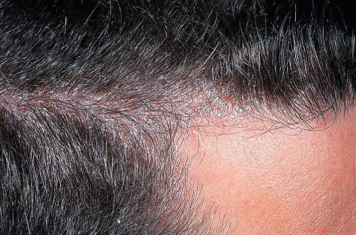 Fig. 5.15, Scalp psoriasis. Sometimes it is impossible to distinguish between scalp psoriasis and seborrheic dermatitis. The ears and faces of patients with seborrheic dermatitis are often involved.