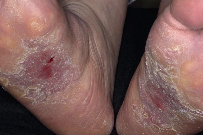 Fig. 5.17, Psoriasis of the soles is painful and responds well to systemic agents.