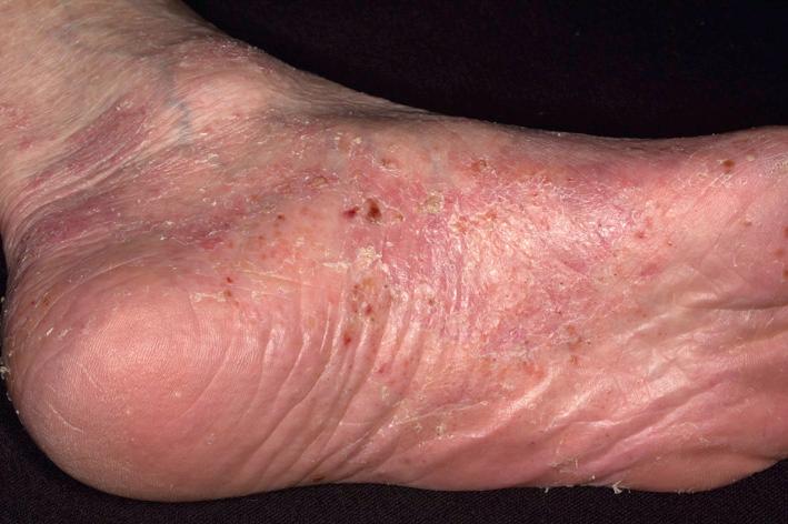 Fig. 5.18, Psoriasis on the soles. Tinea may secondarily infect psoriasis and should be considered if psoriasis fails to respond to topical steroids.