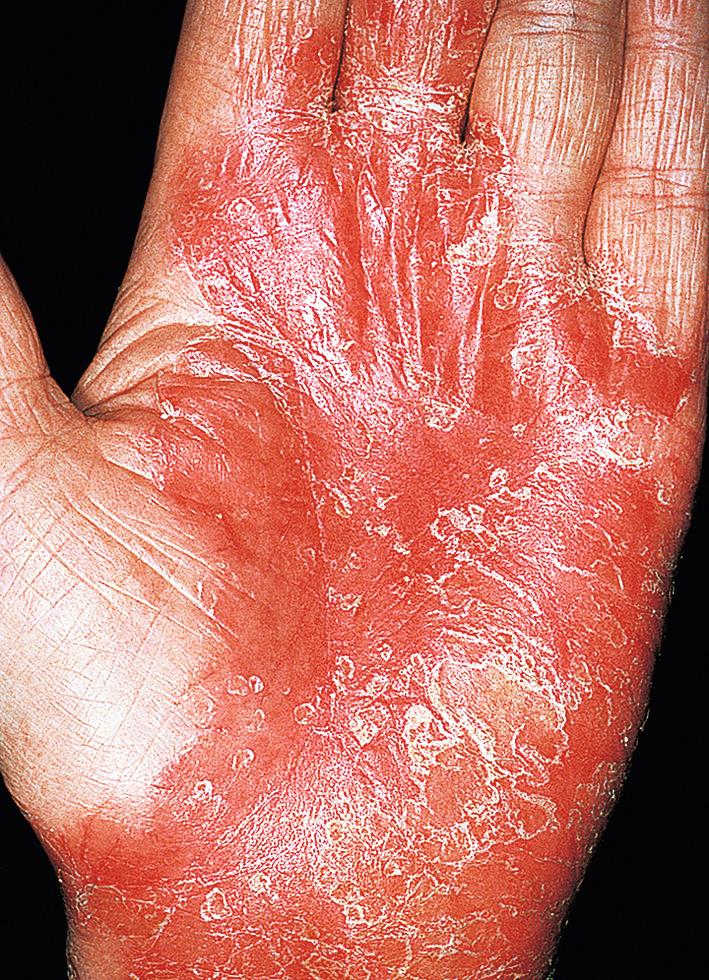Fig. 5.19, Psoriasis of the palms. This deep red, smooth plaque is painful.