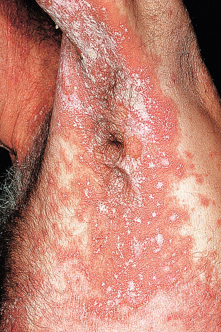 Fig. 5.20, Pustular psoriasis. This rare form of psoriasis can be extensive and serious. It responds to cyclosporine, methotrexate, or acitretin.