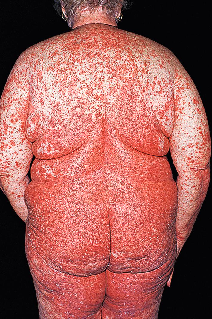 Fig. 5.21, Erythrodermic psoriasis. Generalized intense inflammation can occur and often requires systemic medications for control.