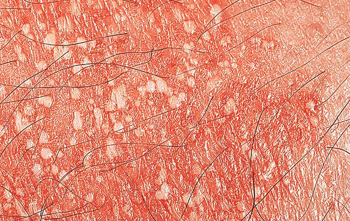 Fig. 5.22, Pustular psoriasis. Pustules may coalesce, forming small “lakes of pus.”