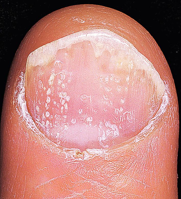 Fig. 5.23, Psoriasis pitting. Foci of inflammation of the proximal nail matrix results in the accumulation of parakeratotic cells on the nail surface. These are shed as the nail grows out, leaving depressions or pits in the nail surface.