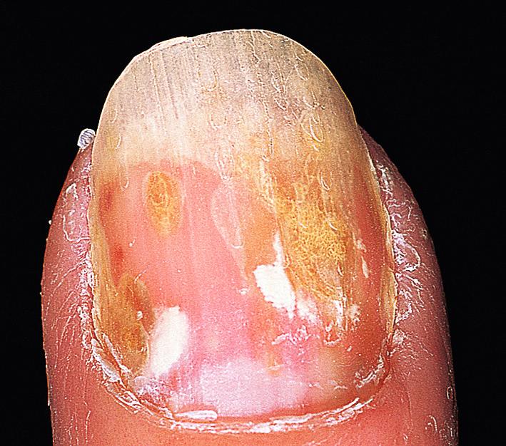 Fig. 5.24, Psoriasis oil-spot lesion. Accumulation of parakeratotic debris and serum under the nail produces a yellow-brown stain under the nail.