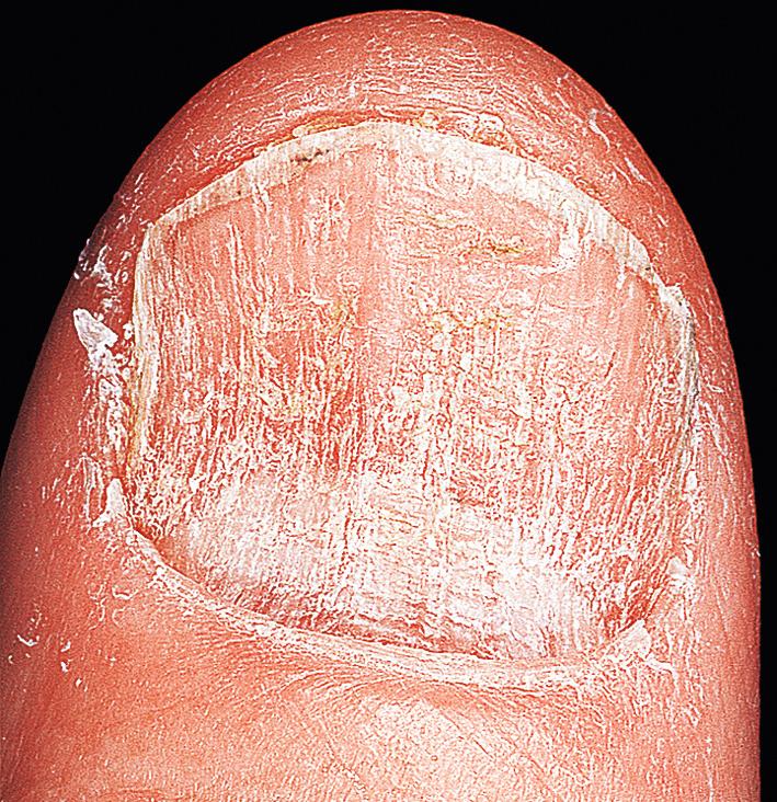 Fig. 5.25, Psoriasis nail deformity. Inflammation of the proximal nail matrix causes surface deformity of the nail plate.