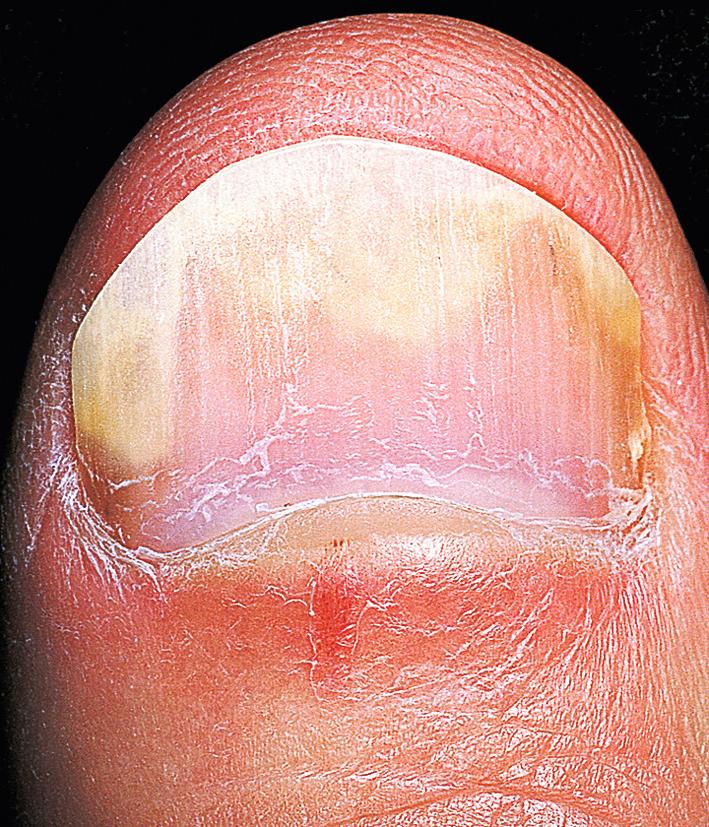 Fig. 5.26, Psoriatic onycholysis. Psoriatic inflammation of the skin at the fingertip causes distal nail plate separation. The picture can be identical to that seen with traumatic onycholysis.