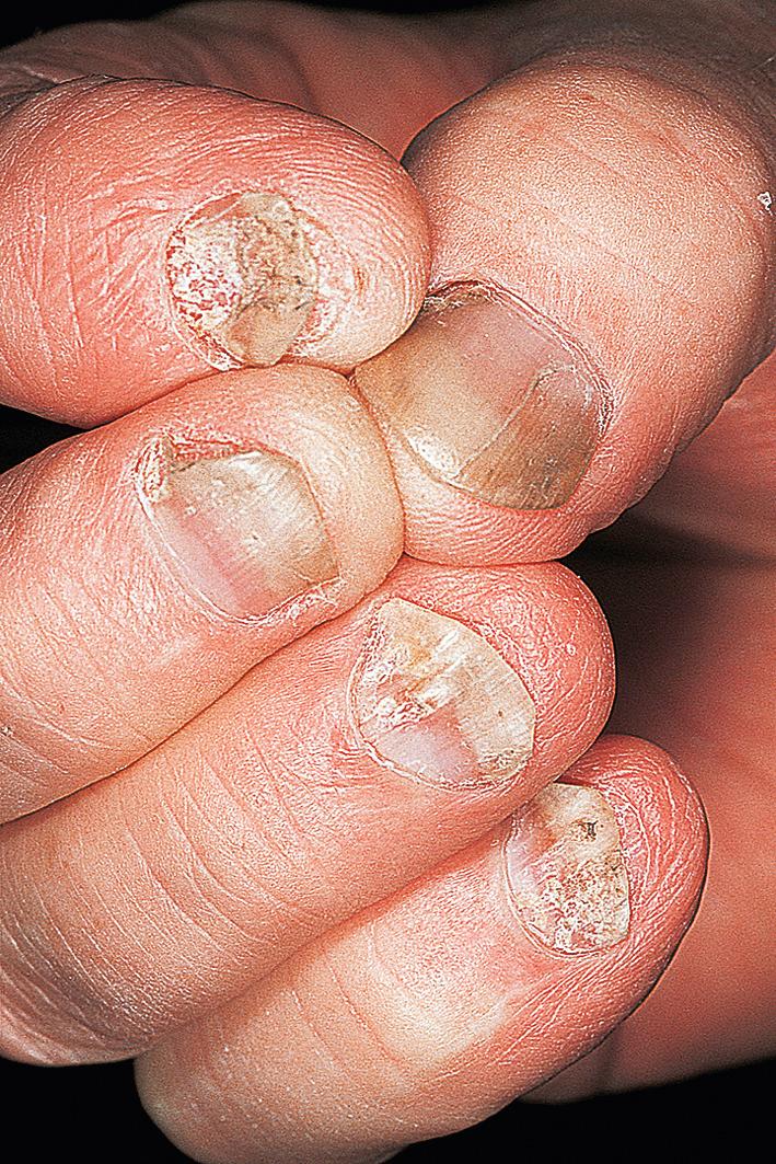 Fig. 5.27, Psoriasis onycholysis and nail deformity. Inflammation of various parts of the nail matrix produces a bizarre pattern of nail deformity. Clinical differentiation from onychomycosis is sometimes difficult.