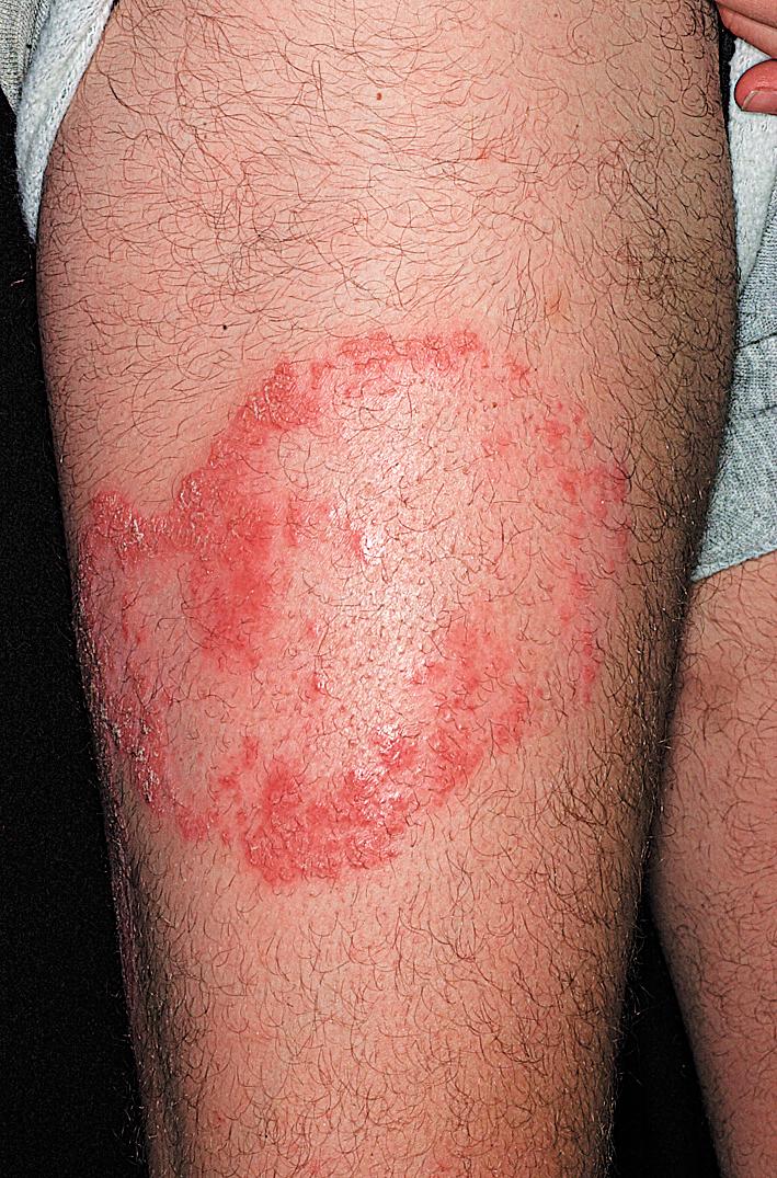 Fig. 5.28, Psoriasis. Typically, treated psoriasis plaques clear in the center and then gradually improve at the periphery.