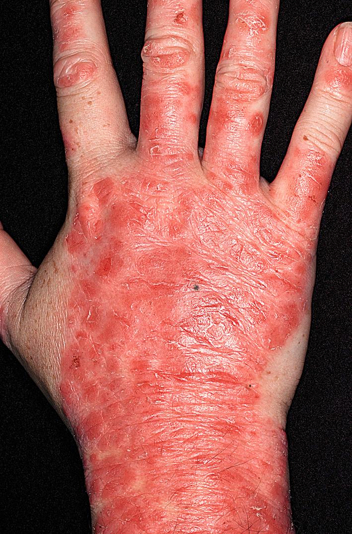 Fig. 5.29, Inflammatory plaque psoriasis may be painful. This active disease failed to respond to topical steroids, and methotrexate was started.
